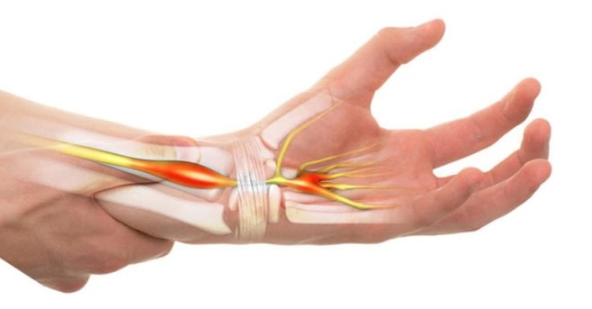 hội chứng ống cổ tay ở dân văn phòng